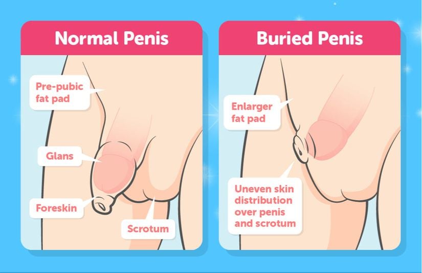 Normal Penis (Solda) vs. Gömülü Penis Sendromu (Sağda)