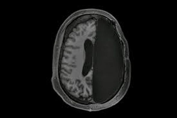 Beyninin yarısı alınmış bir hasta