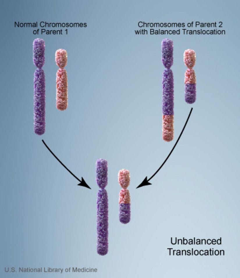 Dengesiz Translokasyon.   (Sol üstte normal kromozomlu ebeveynin, sağ üstte dengeli translokasyona sahip ebeveynin ve altta dengesiz translokasyona sahip çocuğun kromozomları görülmektedir.)