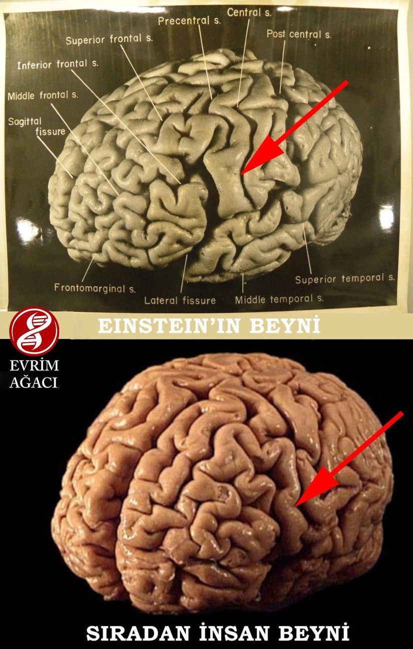 Einstein'ın beyninde, normalde bulunması gereken parietal operkulum'un oluşmadığı, bu nedenle normalden %15 genişleyebilen/irileşebilen inferior pariyetal lobun bulunduğu bölge.