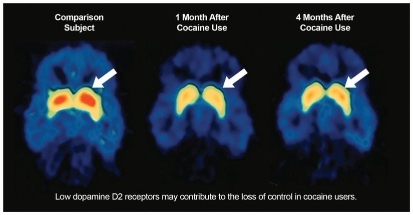 Bu fMRI görüntüleri, kokain kullanım bozukluğu öyküsü olan bir bireyin beynini (ortada ve sağda) kokain kullanım öyküsü olmayan bir bireyin beyniyle (solda) karşılaştırır. Kokain kullanım bozukluğu olan kişinin, kokain kullanımını bıraktıktan bir ay sonra (ortada) ve dört ay sonra (sağda) striatumda D2 dopamin reseptörü (kırmızı ile gösterilen) seviyesi, kullanmayan kişiye göre daha düşüktür. Kokain kullanıcısının beynindeki dopamin reseptörlerinin seviyesi 4 aylık işarette (sağda) daha yüksektir, ancak kullanmayanlarda (solda) gözlenen seviyelere geri dönmemiştir.