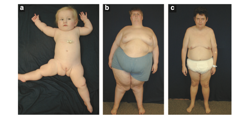 (a) Hipotoni, hipogonadizm ve yardımlı beslenme ihtiyacı olan 8 aylık bir kız çocuğu.  (b) Prader-Willi Sendromu'nun tipik vücut habitusunu gösteren, öncelikle karın, kalça ve uyluklarda yağ dağılımı olan, yetersiz diyet kontrolüne sahip 19 yaşında bir erkek.  (c) Özel bir Prader-Willi Sendromu grup evinde yaşayan, nispeten iyi diyet kontrolüne sahip 34 yaşında bir erkek. Morbid obezite geçmişinden kalan sarkık deriye dikkat edin. (Bu fotoğrafların yayınlanması için bilgilendirilmiş onam alınmıştır).