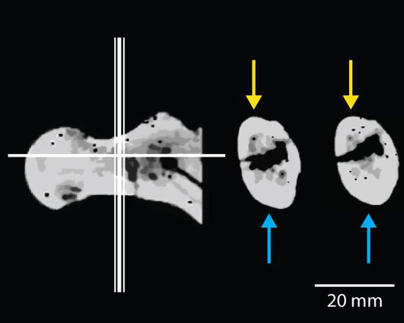 Orrorin tugenensis’e ait örneklerden BAR 1002’00’ın femur boynunun CT taraması. En soldaki görüntüde femur boynundan alınan enine kesitlerin yeri (orta ve sağdaki görüntüler) gösteriliyor. Femur boynundaki kortikal kemiklerin dağılımı asimetrik ve korteksin alt kısmı (mavi ok ile gösterilen) üst kısmından (sarı ok ile gösterilen) daha kalındır. Modern insanlar da kortikal kemikte benzer asimetrik dağılıma sahipken Afrika insansıları daha simetrik dağılıma sahiptir ve bunun nedeni iki ayaklılık ile dört ayaklılığın ayağa farklı yükler uygulamasıdır.