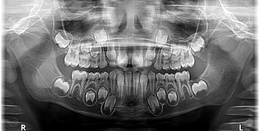 Çocukların çenelerinde süt dişlerinin arkasında gelişerek sırasını bekleyen kalıcı dişler bulunur.