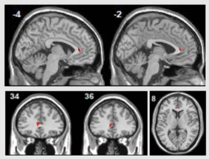 Majör depresyon hastaları psikolojik terapinin ardından sol rostral ön singulat kortekslerinde aktivite artışı göstermişlerdir. Görsel: Sankar et al, 2018
