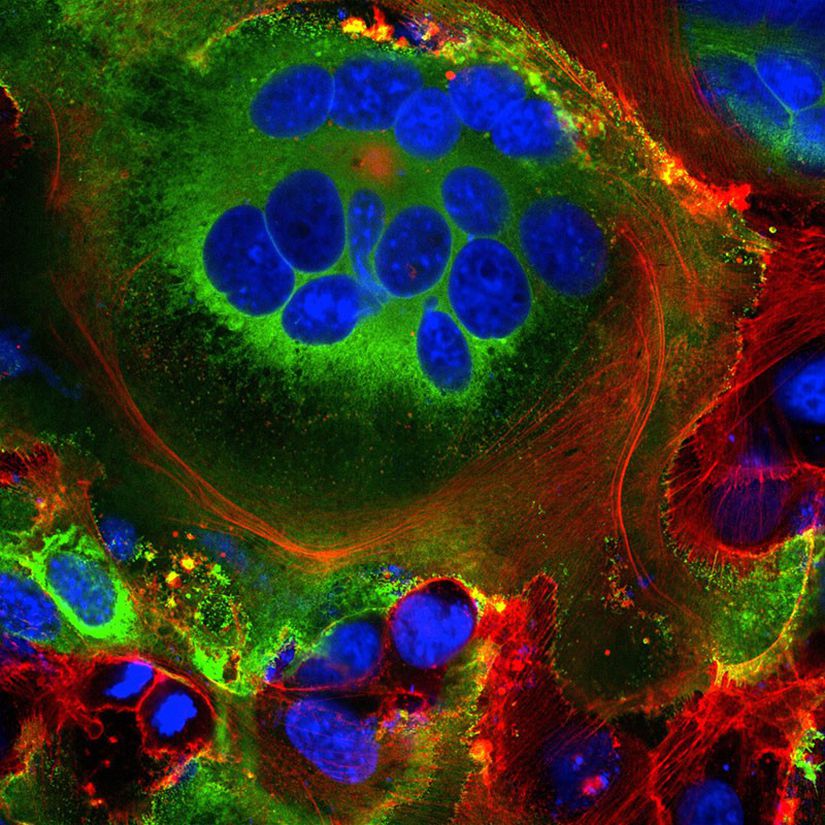SARS-CoV-2 mızrak proteini (yeşil) eksprese eden hücrelerde görülen kaynaşmış hücre yapıları (Sinsitya). Hücre çekirdeği mavi, hücre iskeleti kırmızı renkte.